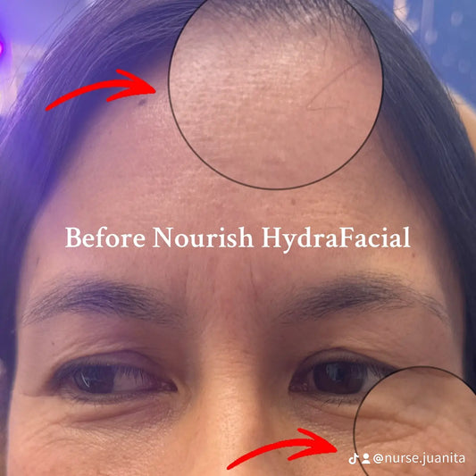 Hydrafacial