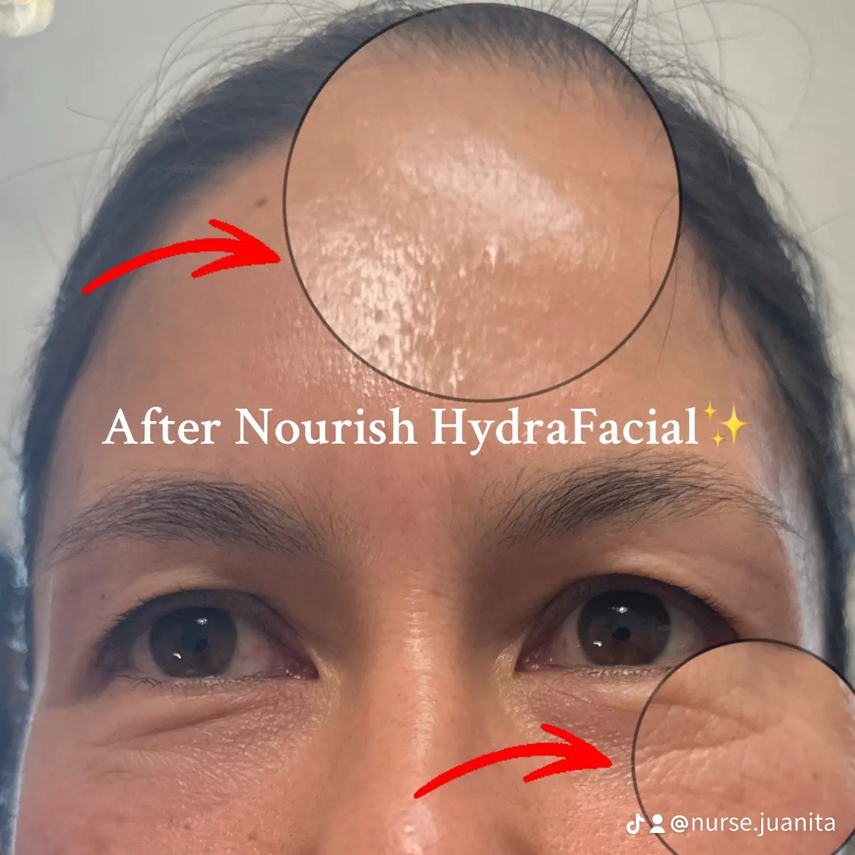 Hydrafacial